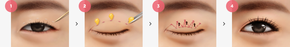 Non-incision Eye Shape Correction Surgery Method