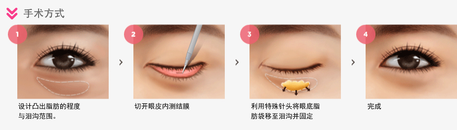 One Day Under Eye Fat Reposition - Surgery Method