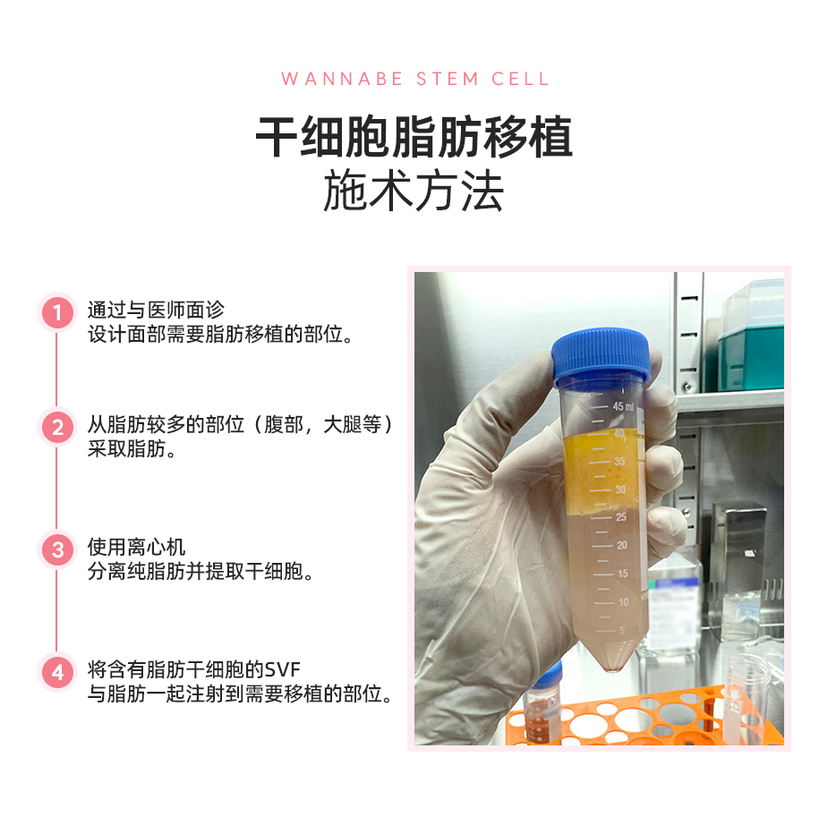 干细胞脂肪移植施术方法 - 1. 通过与医师面诊设计面部需要脂肪移植的部位。2. 从脂肪较多的部位（腹部，大腿等）采取脂肪。3. 使用离心机分离纯脂肪并提取干细胞。4. 将含有脂肪干细胞的SVF与脂肪一起注射到需要移植的部位。