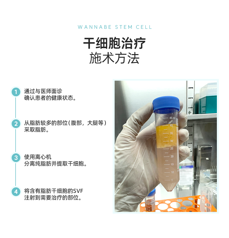 干细胞脂肪移植施术方法 - 1. 通过与医师面诊设计面部需要脂肪移植的部位。2. 从脂肪较多的部位（腹部，大腿等）采取脂肪。3. 使用离心机分离纯脂肪并提取干细胞。4. 将含有脂肪干细胞的SVF与脂肪一起注射到需要移植的部位。